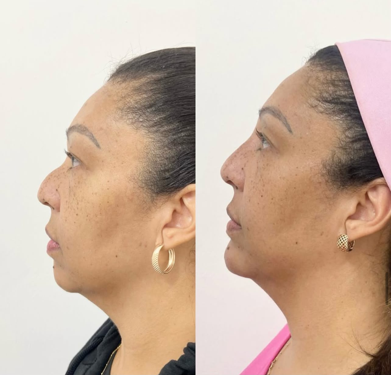 Harmonização & skincare
